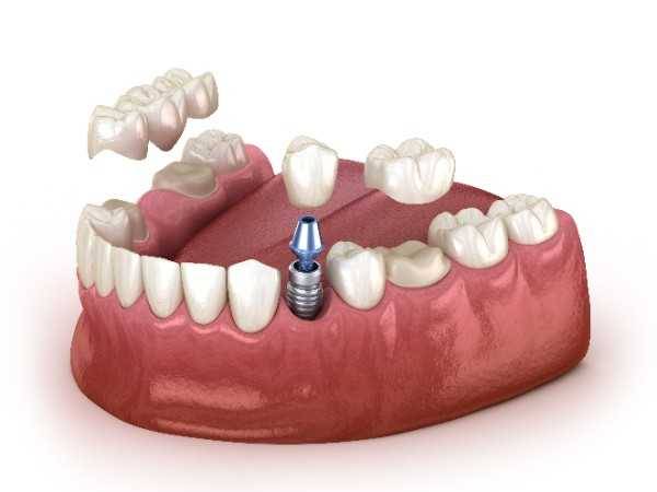 dental implant Birmingham