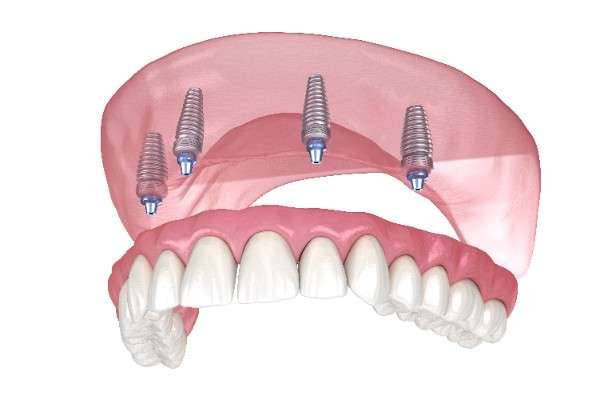 dental implant Birmingham